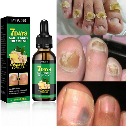 Aceite anti-hongos uñas